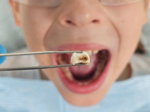 Best Emergency Root Canal Treatment in Foscoe, NC